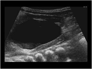 Ureteropelvic junction stenosis with a dilatated left kidney longitudinal