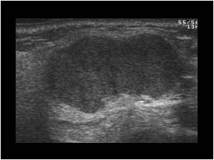 pleomorphic adenoma submandibular gland ultrasound A prosztatitisben kórházi lapot vagy sem