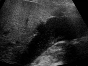 Acalculous cholecystitis with perforation