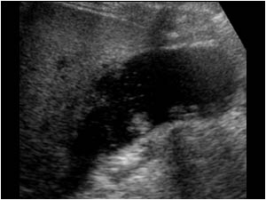Acalculous cholecystitis with perforation