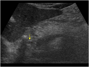 Normal pancreas without dilatation of the distal bile duct transverse