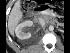 Obstruction and blow out of the right kidney