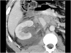 Obstruction and blow out of the right kidney
