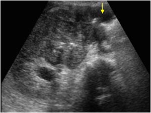 Renal mass invading the duodenum transverse