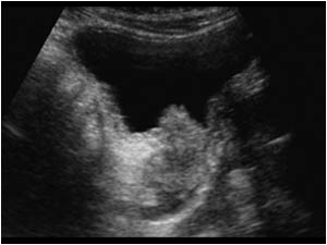 Mass in the distal ureter and bladder longitudinal