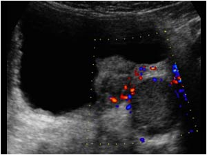 Vascularized mass in the distal ureter and bladder transverse