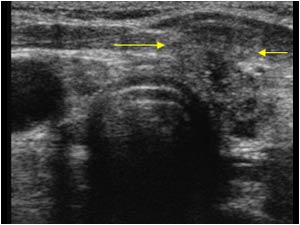 Mass infiltrating the muscles distal to the thyroid gland transverse