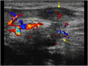 Mass infiltrating the muscles distal to the thyroid gland longitudinal