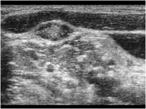 Small but pathological lymphe node on the contralateral side transverse