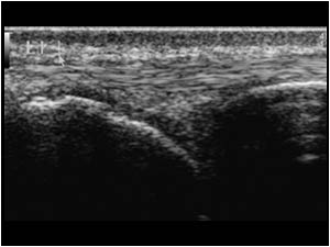 Normal extensor carpi ulnaris tendon longitudinal