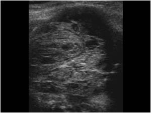 Meniscal cyst with a complex cystic mass