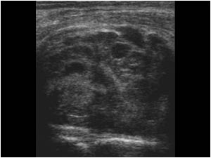 Meniscal cyst with a complex cystic mass