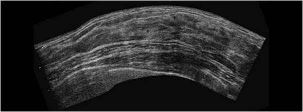 Breast tissue without calcifications