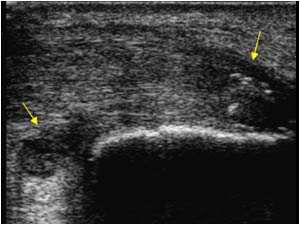 Insertion tendinopathy and bursitis of the deep bursa longitudinal