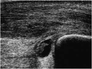 Tendinosis of the distal achilles tendon and fluid filled bursa