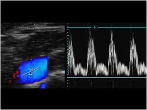 Doppler signal in the subclavian artery
