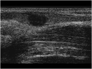 Benign fibrous tumor in the cephalic vein longitudinal
