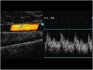 Doppler signal in the proximal radial artery