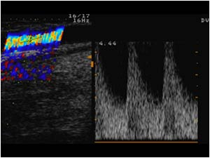 Stenotic area in the efferent vein with systolic velocities of 4,5 mtr/sec