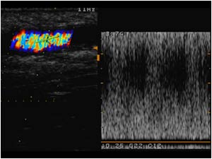 Stenosis in the efferent vein with systolic velocities of more than 4 mtr/sec