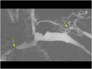 Stenosis in the cephalic vein and subclavian vein