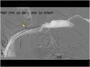 Stent in the subclavian vein
