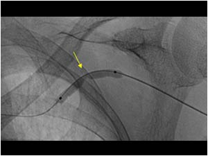 Dilatation of the stenosis in the cephalic vein