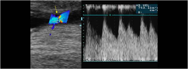 Stenosis in a dialysis fistula in the upperleg with systolic velocities of more than 7 mtr/sec