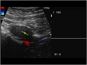 Occluded distal abdominal aorta without detectable flow
