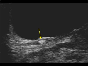 Distal ureteric stone in the left ureter