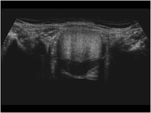 Dermoid cyst with hyperechoic fatty contents
