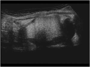 Dermoid cyst with hyperechoic fatty contents
