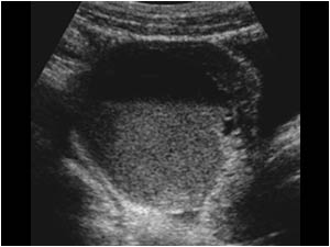 Hemorrhagic ovarian cyst