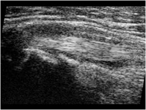 Biceps tendon anterior of the lesser tubercle longitudinal