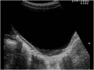 Ovarian cyst longitudinal