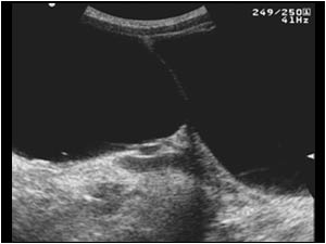 Ovarian cyst and bladder longitudinal before voiding