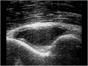 Effusion and synovial thickening in the coronoid fossa