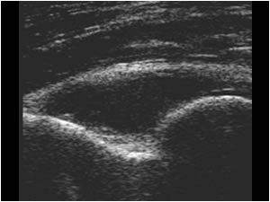 Effusion and synovial thickening in the coronoid fossa