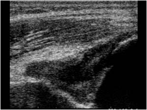 Effusion and synovial thickening in the olecranon fossa