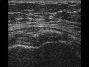 Calcifications in the tendon and in the bursa