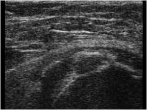 Calcifications in the tendon and in the bursa
