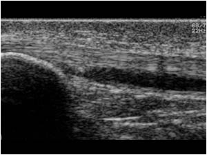 Longitudinal fissure with fluid in the right patellar tendon longitudinal