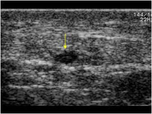 Longitudinal fissure with fluid in the right patellar tendon longitudinal