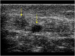 Longitudinal fissure and an area of tendinosis in the right patellar tendon longitudinal