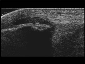 Cartilage swelling and bony fragmentation of the lowerpole of the patella longitudinal
