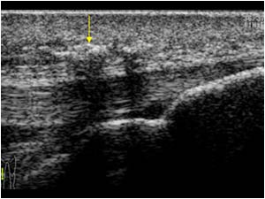 Soft tissue calcifications anterior of the right patellar tendon longitudinal