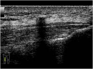 Soft tissue calcifications anterior of the right quadriceps tendon longitudinal