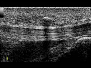 Soft tissue calcifications anterior of the left patellar tendon longitudinal