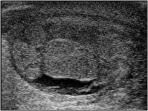 Thickened epididymis on the left side