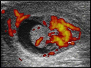 Epididymis with hypervascularization and a reactive hydrocele